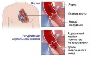 Аортальная недостаточность 1-4 степени: причины и симптомы, лечение и прогноз