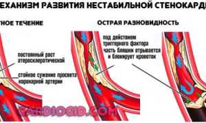 Описание, признаки, классификация и лечение нестабильной стенокардии