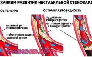 Описание, признаки, классификация и лечение нестабильной стенокардии