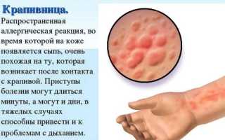 Крапивница: фото, симптомы и лечение у взрослых, детей. Как выглядит аллергическая, идиопатическая, острая, хроническая, холодовая. Препараты, диета, мази
