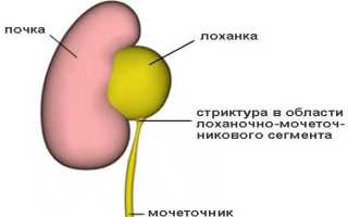 Стриктуры мочеточника — почему появляются и как их лечить