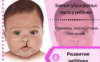 Хейлосхизис (волчья пасть, заячья губа): что это, причины возникновения, симптомы, фото детей до и после операции