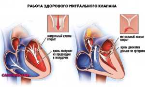 Причины митральной регургитации 1-4 степени, как выявить проблему и способы лечения