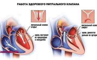 Причины митральной регургитации 1-4 степени, как выявить проблему и способы лечения