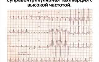 Особенности пароксизмальной наджелудочковой (суправентрикулярной) тахикардии