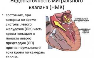 Митральная недостаточность 1-4 степени: причины и симптомы, лечение и прогноз жизни