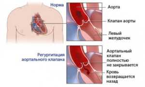 Аортальная недостаточность 1-4 степени: причины и симптомы, лечение и прогноз