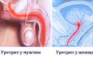 Замучала боль при мочеиспускании? Дополните лечение уретрита народными средствами!