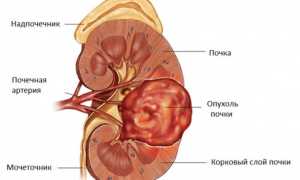 Рак почек: первые симптомы, стадии, лечение, прогнозы