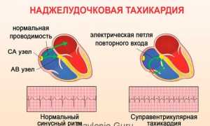 Особенности пароксизмальной наджелудочковой (суправентрикулярной) тахикардии