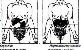 Гастроптоз: виды, причины, признаки, симптомы, лечение