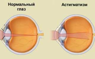 Врачебное мнение о том, нужно ли лечить астигматизм у ребёнка
