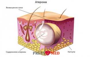 Как определить у себя атерому (кисту сальной железы) и благополучно излечить её