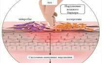 Чем лечить экзему на руках: лечение мазями, препаратами, народными средствам