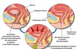 Уретрит у женщин: как вовремя обнаружить и устранить?