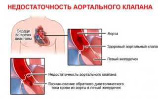 Митральная недостаточность 1-4 степени: причины и симптомы, лечение и прогноз жизни