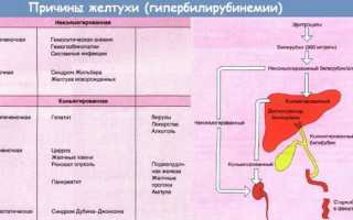 Желтуха у взрослых: причина, диагностика и лечение