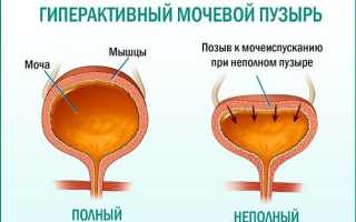 Как проявляется и можно ли вылечить гиперактивность мочевого пузыря