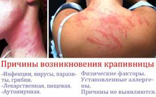 Крапивница: фото, симптомы и лечение у взрослых, детей. Как выглядит аллергическая, идиопатическая, острая, хроническая, холодовая. Препараты, диета, мази