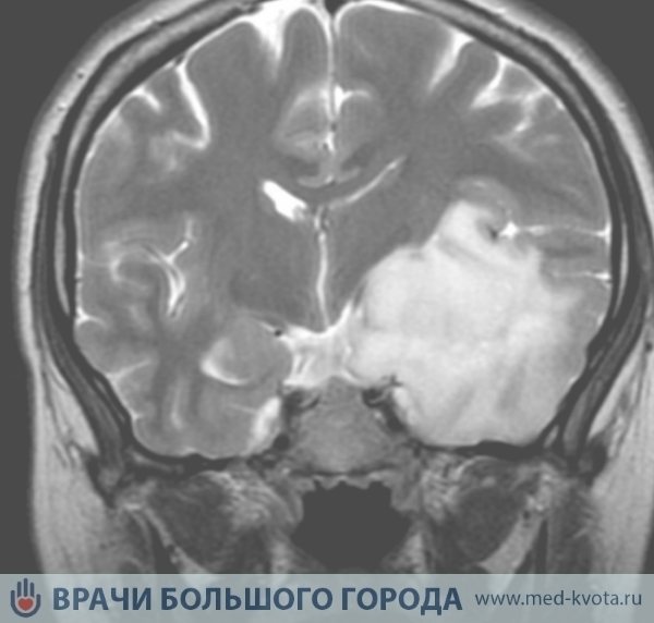 Астроцитома головного мозга - причины, симптомы, диагностика и лечение