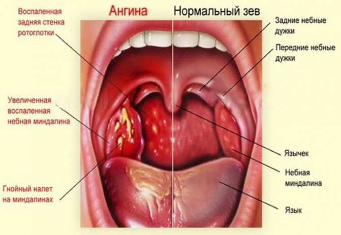 Белый, бело-желтый налет на языке у взрослых. Причины, лечение, как устранять