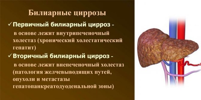 Билиарные циррозы