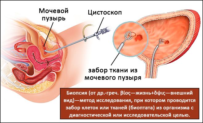 Биопсия