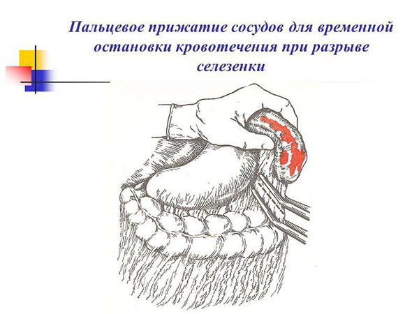 Чем опасен разрыв селезенки