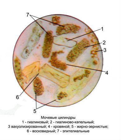 Цилиндры в моче