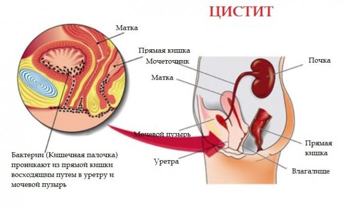 цистит