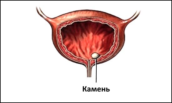Цистолитиаз