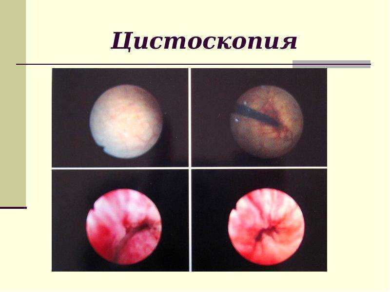 Цистоскопия при беременности расшифровка