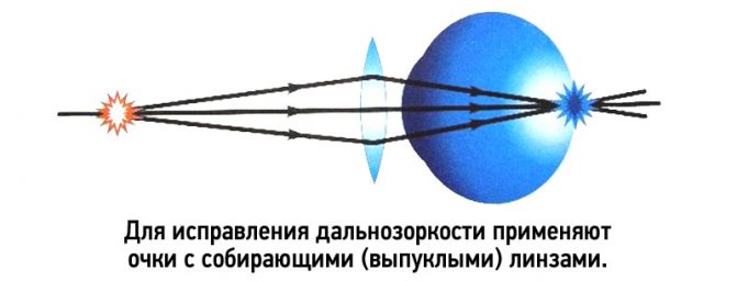 Дальнозоркость (гиперметропия)