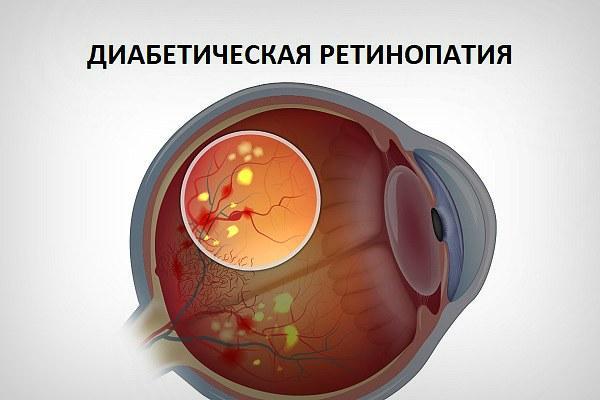 Диабетическая ретинопатия