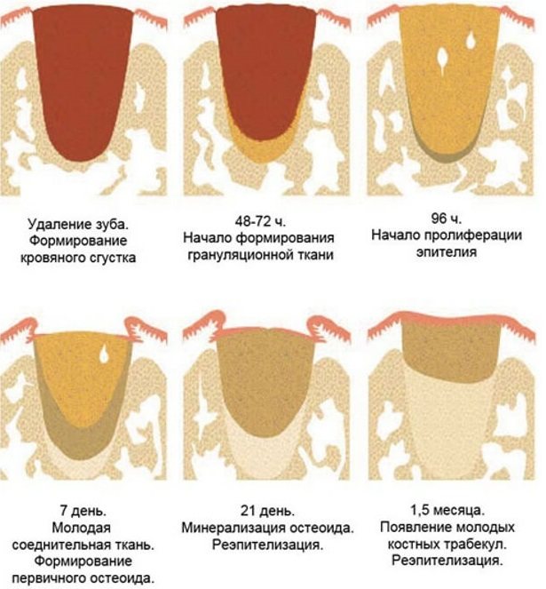 Этапы заживления лунки после удаления зуба