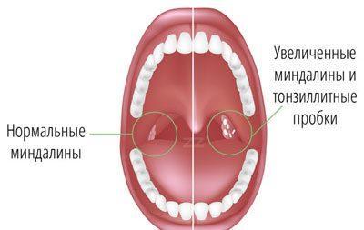 Горло при хроническом тонзиллите