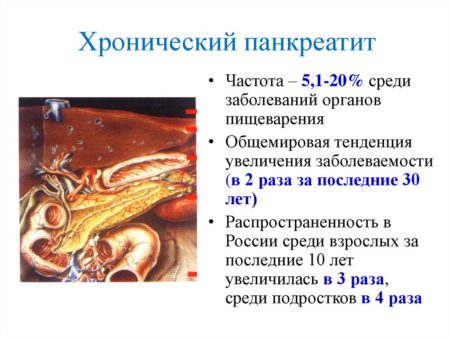 Хронический панкреатит