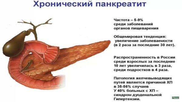 Хронический панкреатит