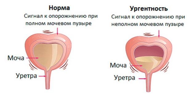 Как проявляется недержание мочи