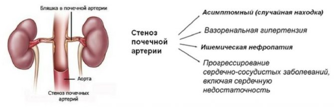 Каптоприл Сандоз - официальная инструкция по применению