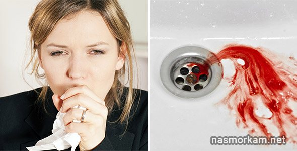 Кашель с мокротой с кровью: причины. Что делать? Лечение