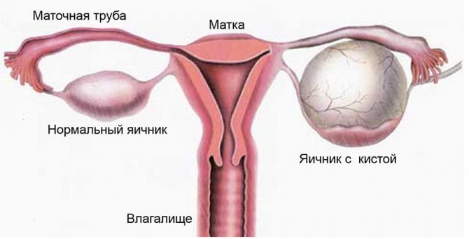 Киста яичника