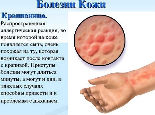 Крапивница: фото, симптомы и лечение у взрослых, детей. Как выглядит аллергическая, идиопатическая, острая, хроническая, холодовая. Препараты, диета, мази