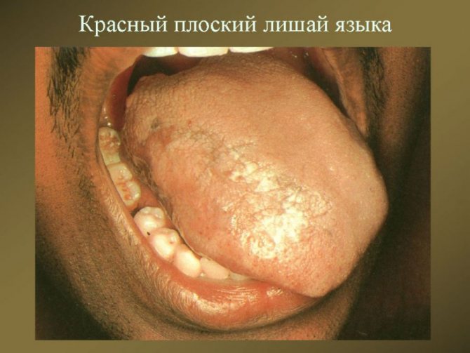 Красный плоский лишай языка