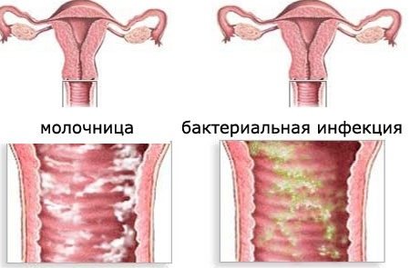 Лечение дискомфорта в интимной зоне у женщин: сухость, зуд, жжение, раздражение и покраснение. Народные рецепты и аптечные средства