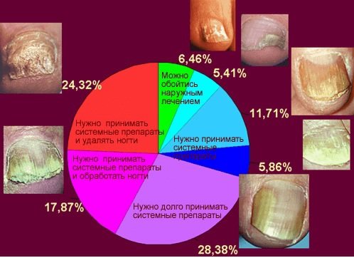 Лечение грибка ногтей