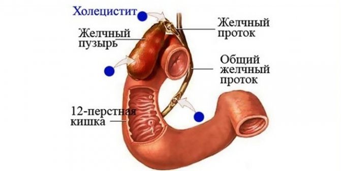 Локализация холецистита