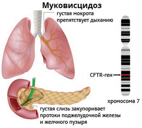 Муковисцидоз
