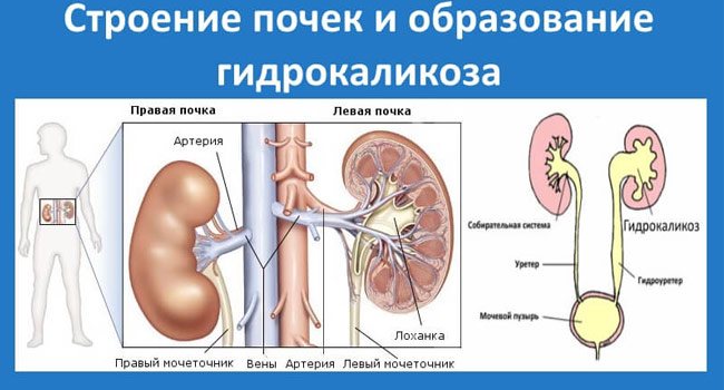 образование гидрокаликоза