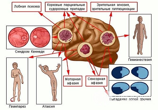 Очаговые симптомы астроцитом